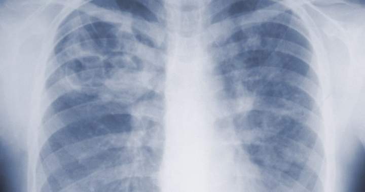 Chest X-ray showing pulmonary aspergillosis, an invasive mold infection, caused by a fungal organism of the genus Aspergillus.