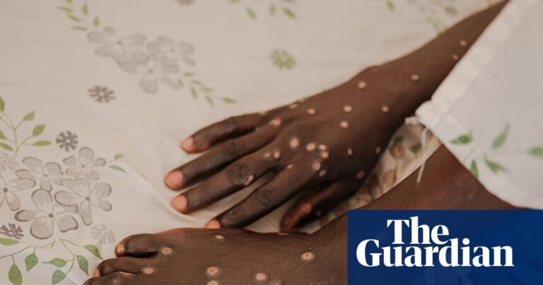 Mpox blisters on human skin, representing the disease